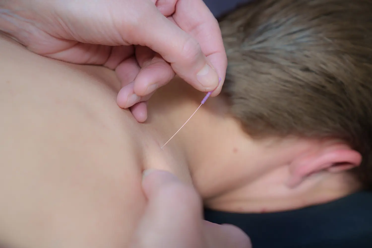 Naald ingebracht tijdens dry needleing bij Manuele therapie Prinsenbeek.